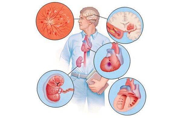 Schädigung verschiedener Organe mit längerer arterieller Hypertonie